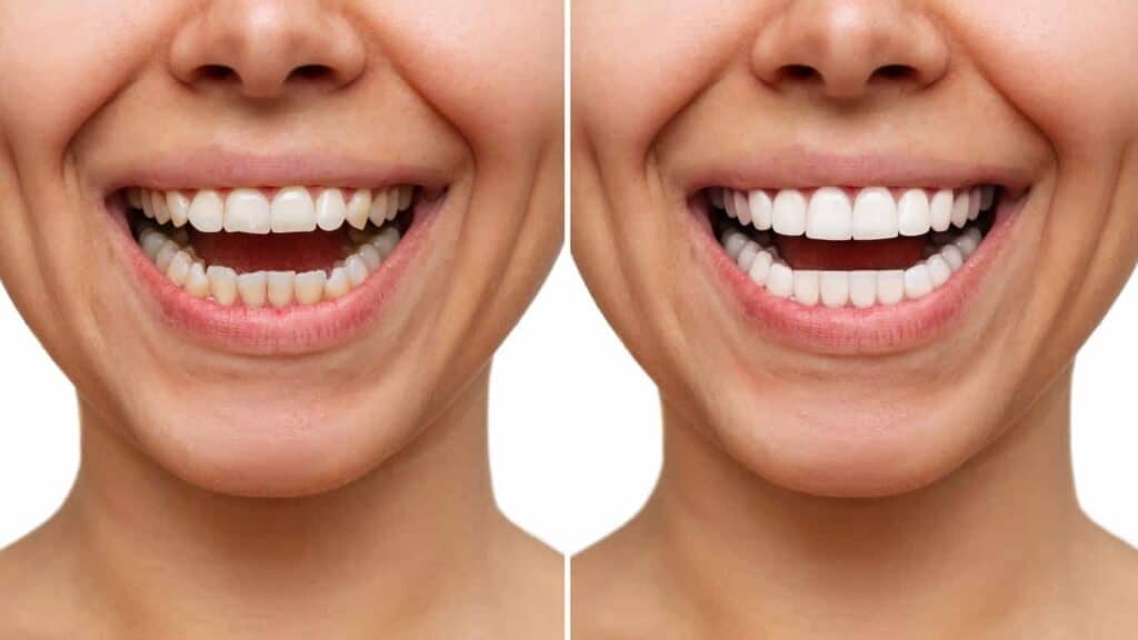 Contact Aspire White for teeth whitening services – Get in touch with Colchester today