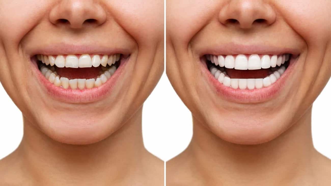 Contact Aspire White for teeth whitening services – Get in touch with Colchester today