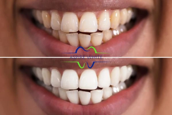 Aspire White customer before and after Colchester results.