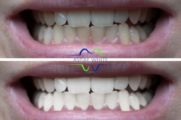 1 hour laser teeth whitening before and after results Colchester