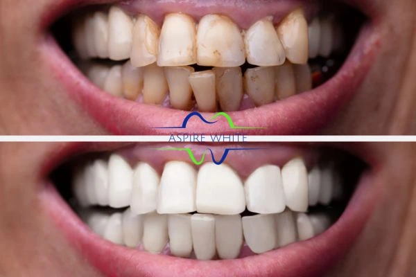 Before and after results of laser teeth whitening Colchester Book in online today!