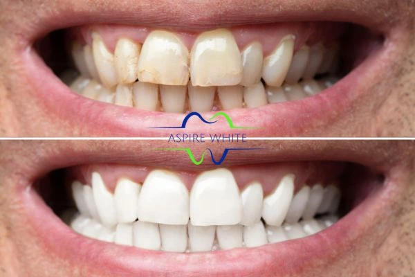 Achieve a radiant smile with professional laser teeth whitening Colchester
